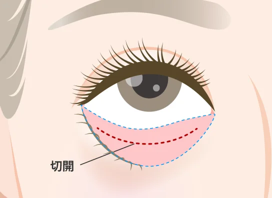 銀座よしえクリニック 裏ハムラ法（経結膜的眼窩脂肪移動術）
