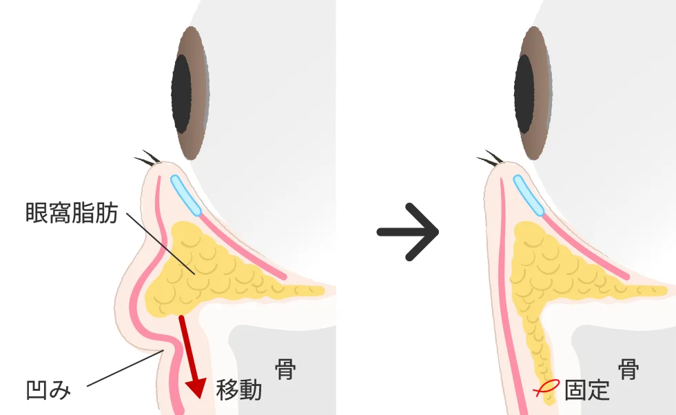 銀座よしえクリニック 裏ハムラ法（経結膜的眼窩脂肪移動術）
