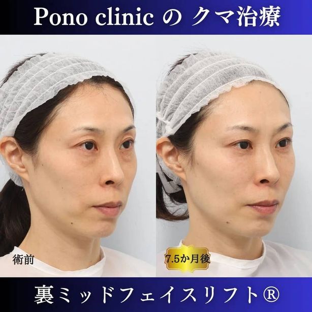 Pono clinicの裏ミッドフェイスリフト®症例画像