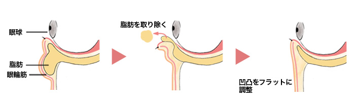 脱脂+脂肪注入の施術解説