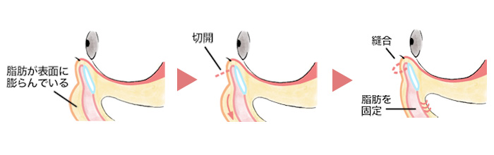 ハムラ法の施術解説