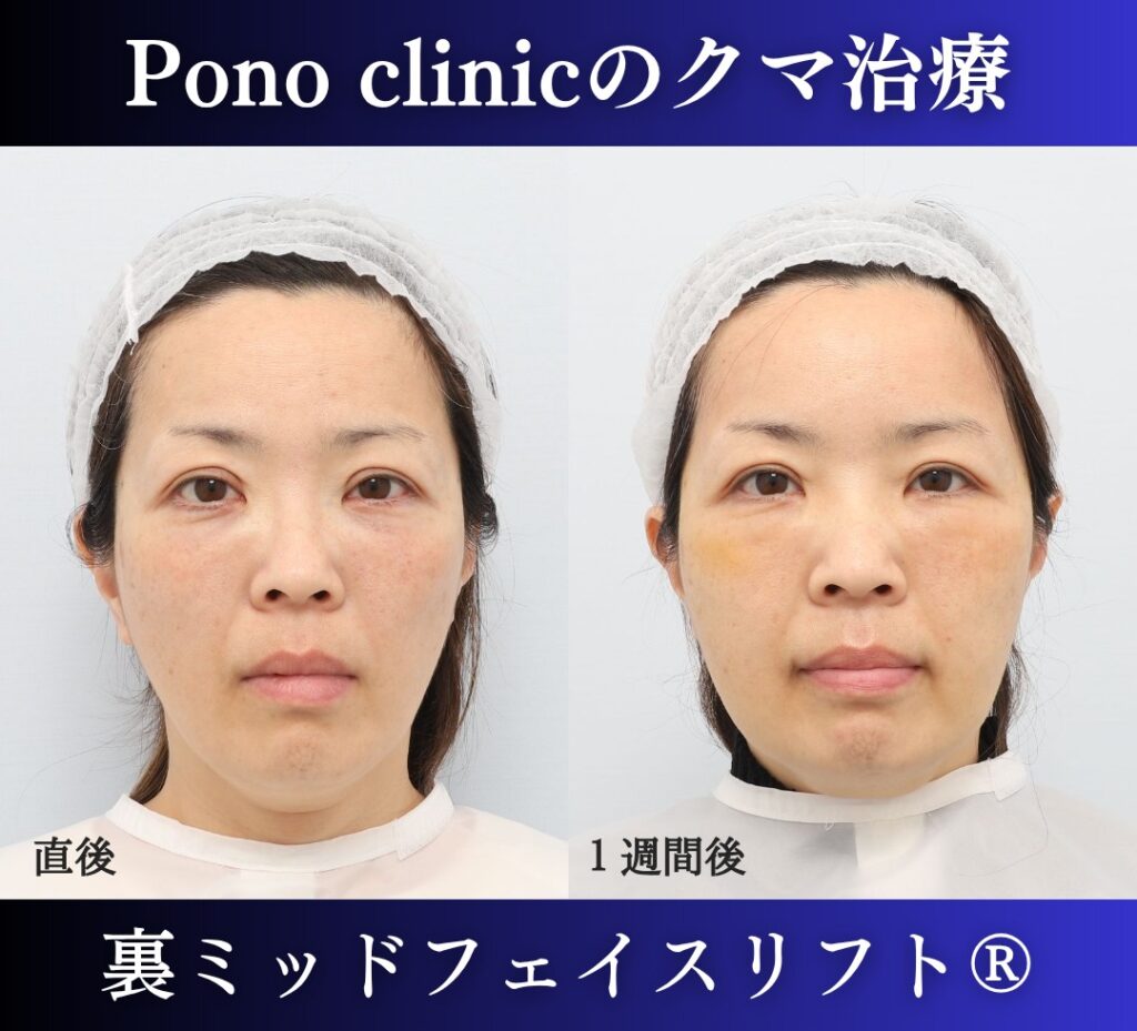 Pono clinicでの50代女性の裏ミッドフェイスリフトの1週間後の症例写真