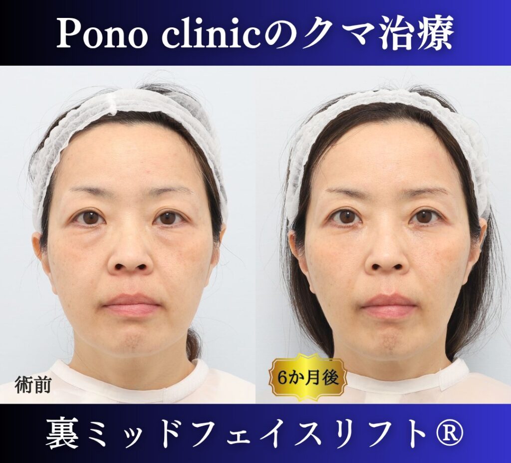 Pono clinicでの50代女性の裏ミッドフェイスリフトの6ヶ月後の症例写真