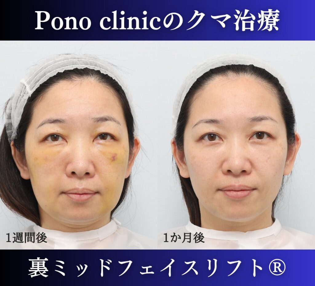 Pono clinicでの40代女性の裏ミッドフェイスリフトの1ヶ月後の症例写真