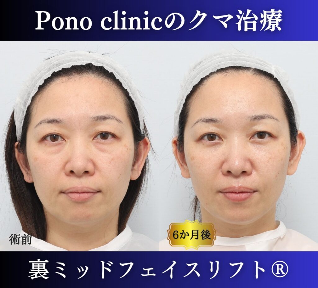 Pono clinicでの40代女性の裏ミッドフェイスリフトの6ヶ月後の症例写真