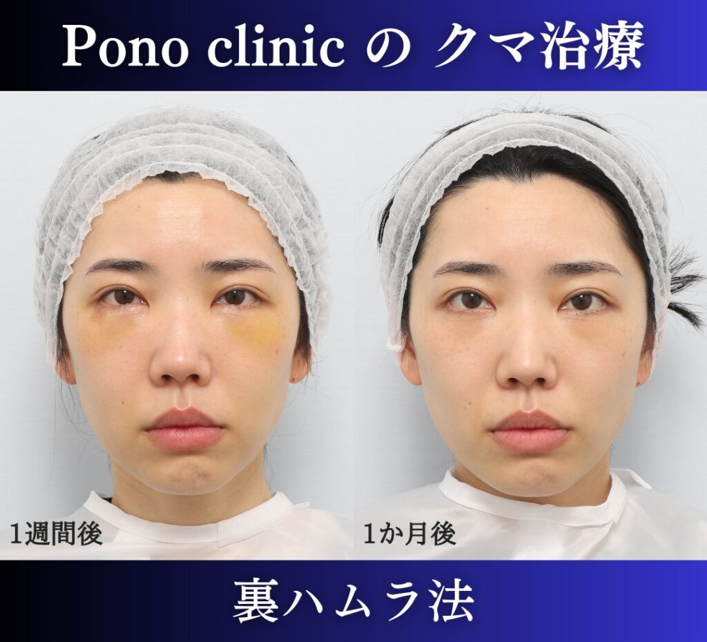 Pono clinicでの30代女性の裏ハムラの1ヶ月後の症例写真
