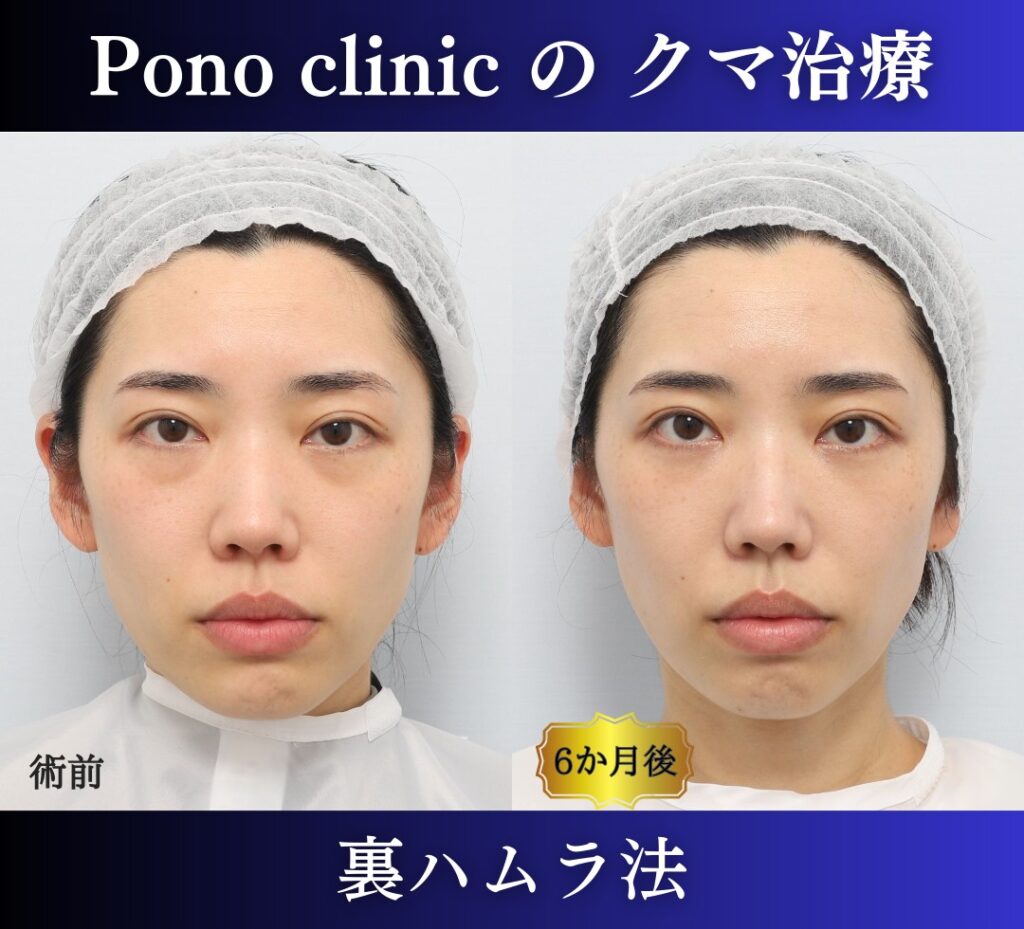 Pono clinicでの30代女性の裏ハムラの6ヶ月後の症例写真