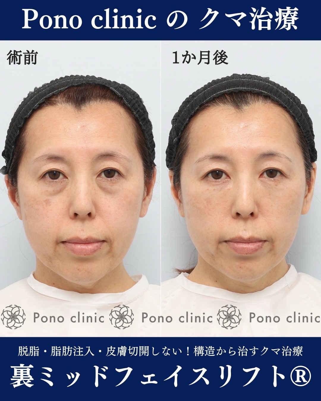 Pono clinicでの50代女性の裏ミッドフェイスリフトの1ヶ月後の症例写真