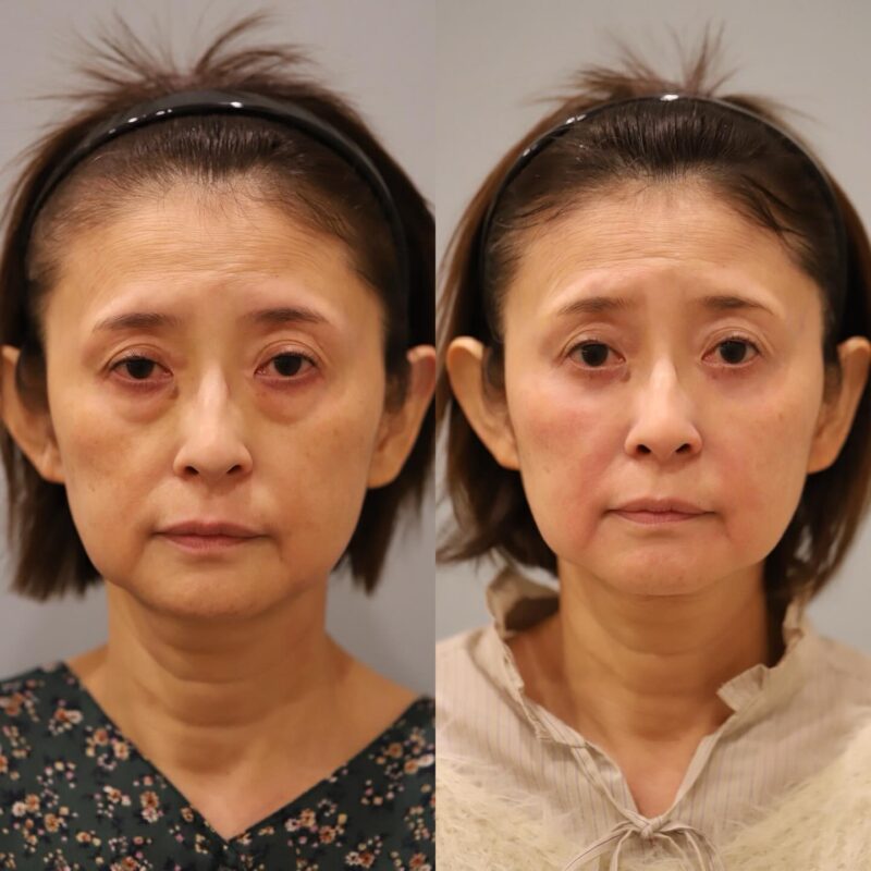 BRクリニック銀座での表ハムラの3ヶ月後の症例写真