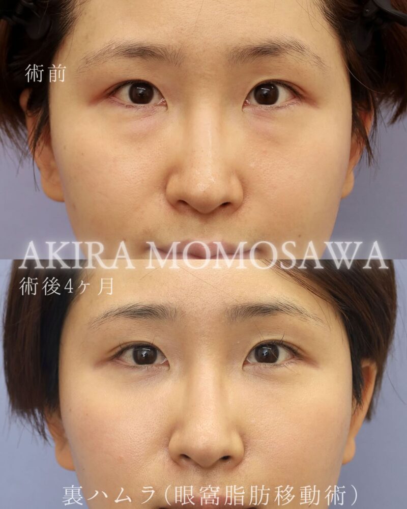 クリニック日比谷での36歳女性の裏ハムラの4ヶ月後の症例写真