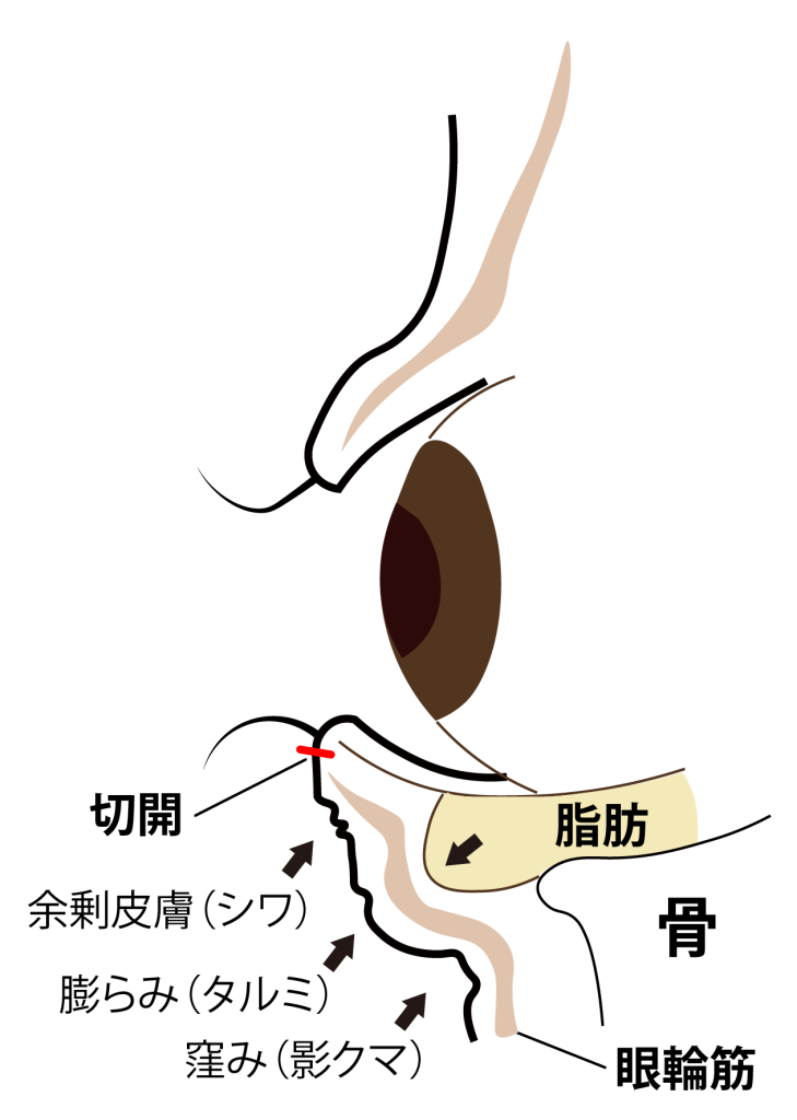 表参道レジュバメディカルクリニックの施術方法図解