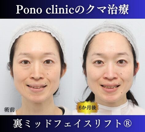 Pono clinicでの40代女性の裏ミッドフェイスリフトの6ヶ月後の症例写真