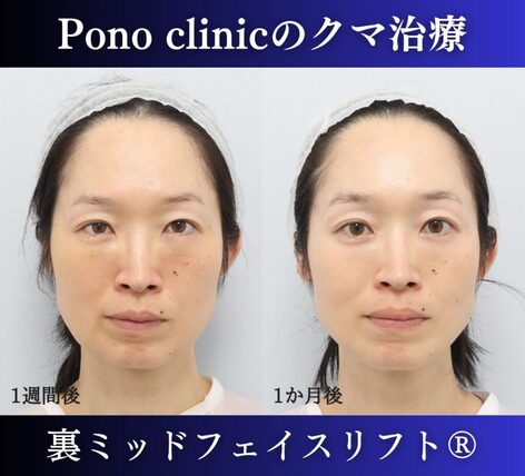 Pono clinicでの40代女性の裏ミッドフェイスリフトの1ヶ月後の症例写真