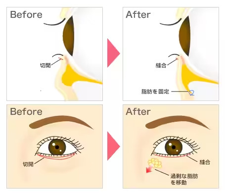 湘南美容クリニックの施術方法図解