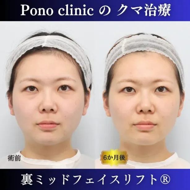 Pono clinicの裏ミッドフェイスリフト®症例