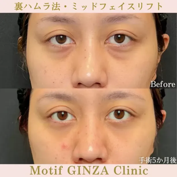 モティーフ銀座クリニックの裏ハムラ×ミッドフェイスリフトの症例