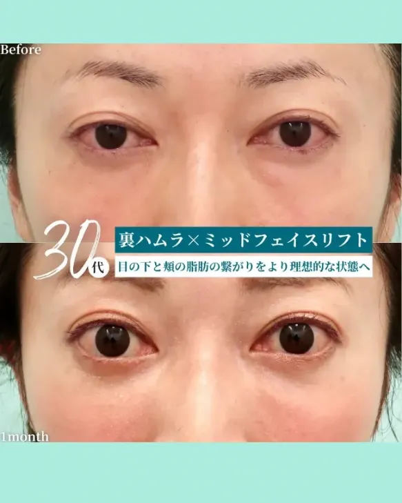 WOM CLINIC GINZAの裏ハムラ×ミッドフェイスリフトの症例