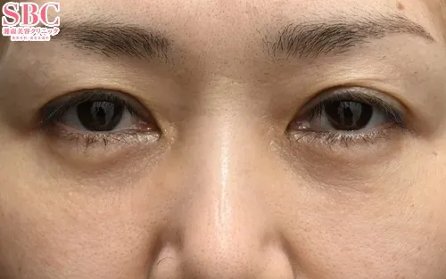 湘南美容クリニックの裏ハムラ×ミッドフェイスリフトの症例